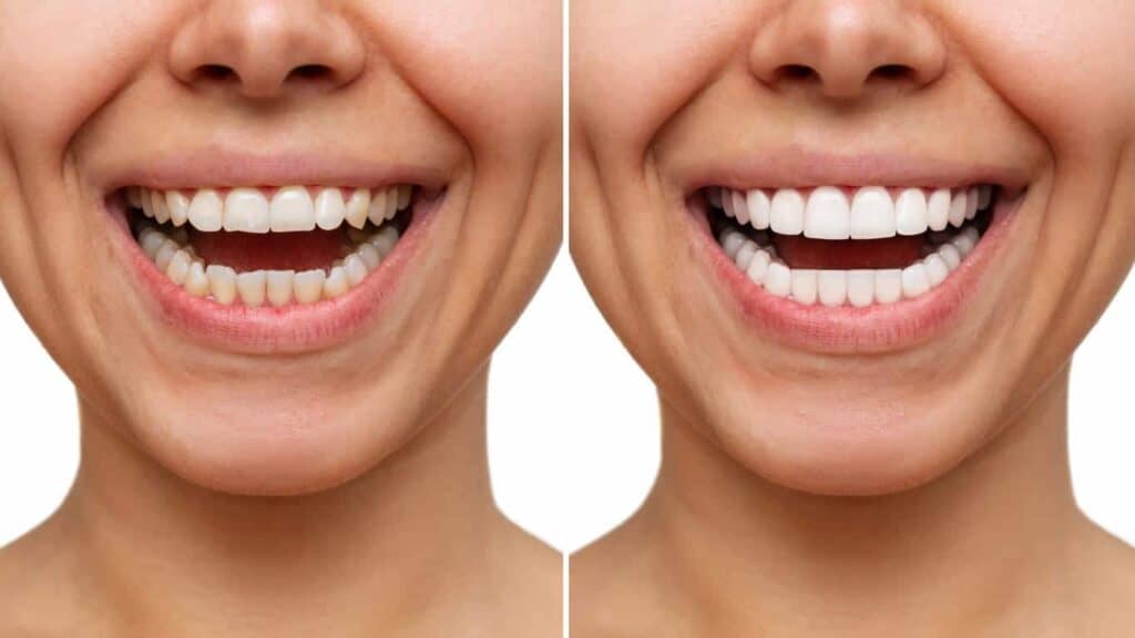 Before and after teeth whitening results. Hinckley