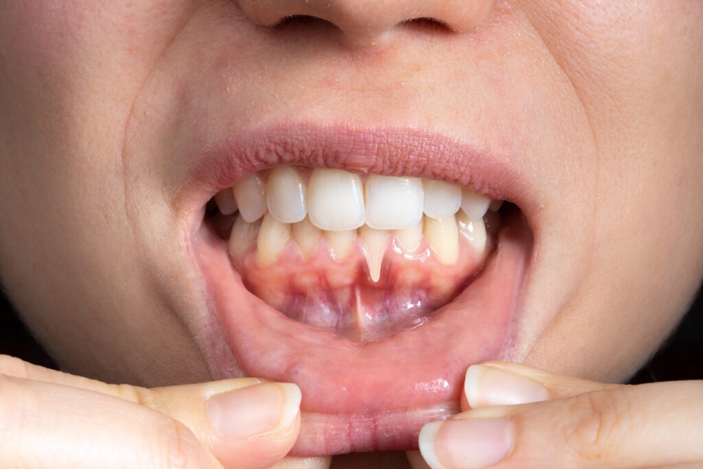Preparing for teeth whitening with receding gums Hinckley