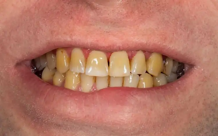 Can Smokers {name} Still Achieve a Bright Smile?